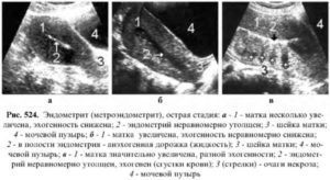 Эндометрий повышенной эхогенности