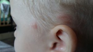 У ребенка после удара над ухом на кости шишка и покраснение