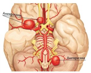 Аневризма основной артерии головного мозга