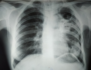 Скрытая пневмония или туберкулез