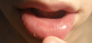 Высыпания на внутренней стороне губы