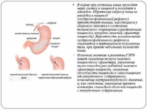 Еда из пищевода возвращается в рот.