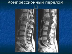 Перелом компрессионный 1-2 степени 12позвонка