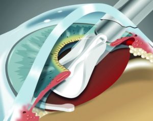 Замена искусственного хрусталика