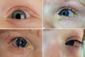 Белые выделения из глаз у ребенка