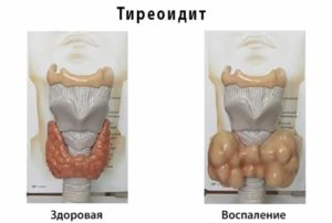 АИТ с узлообразованием