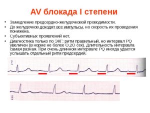 Посмотрите пожалуйста ЭКГ, замедление АВ проводимости