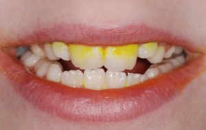 Оранжевый налет на зубах