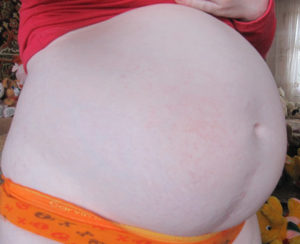 Беременность после кесарева сечения через 1,4 года