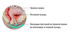 Кишечник давит на мочевой