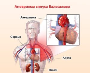 Расширение аорты на уровне синусов Вальсальвы