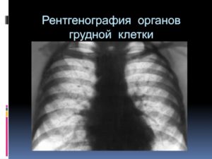 Рентген органов грудной клетки: расшифровка