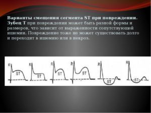 Смещение сегмента ST