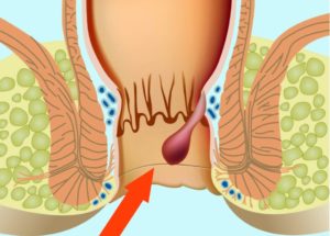 Лечение внутреннего геморроя