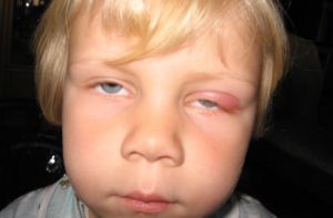 Болит бровь и глаз у ребенка