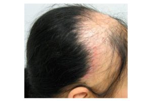 Выпадение волос при аутоиммунных заболеваниях