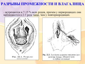 Разрыв входа во влагалище после первого раза