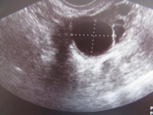 Возможна ли беременность при эндометрии 8,9 мм.?