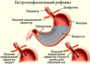 Рефлюкс, отрыжка, изжога, ком в горле, распирание в пищеводе