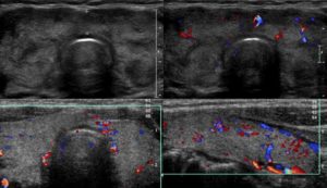 Узи щитовидной железы контуры неровные