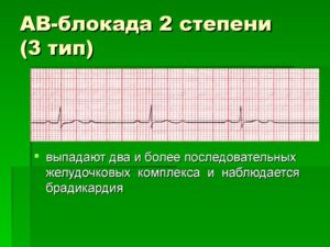 Эпизоды АВ-блокады 2 ст. 2 типа