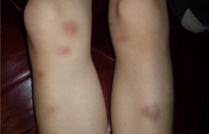 Стали появляться синяки на ногах у ребёнка в 8 лет