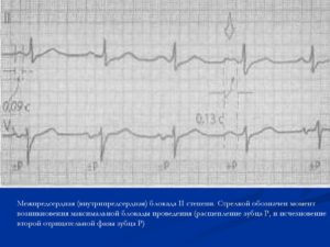 Внутрипредсердная проводимость. ЭКГ при внутрипредсердной блокаде. Замедление АВ проводимости на ЭКГ. Для внутрипредсердной блокады характерно. При замедлении av проведения на ЭКГ.