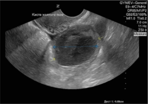 Персистенция желтого тела