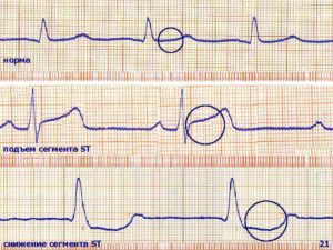 Смещение сегмента ST