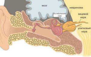 Невринома слухового нерва