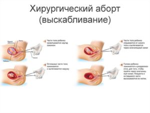 Медикаментозный аборт - вопрос по выделениям