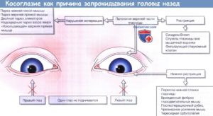 Парез прямых мышц глаза (левого) и ркт