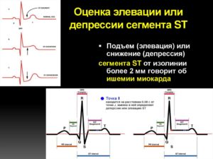 Что значит снижение сегмента ST