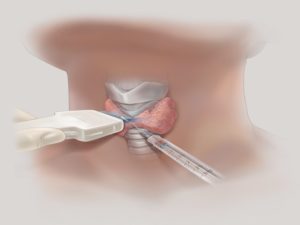 Биопсия щитовидной железы