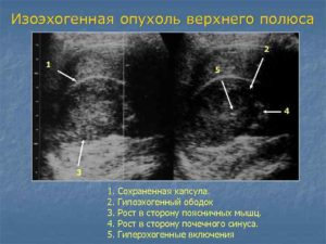 Изоэхогенное образование