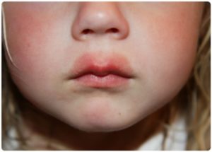 Покраснение вокруг губ у ребенка