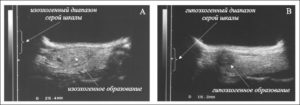 Изоэхогенное образование