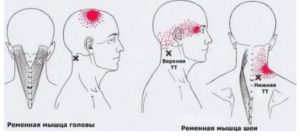 Боль шее слева, отдающая в голову