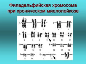 ОЛЛ с филадельфийской хромосомой