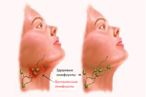 Лимфоузлы на гортани