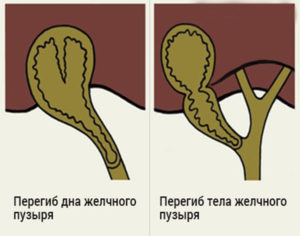 Перегиб желчного пузыря