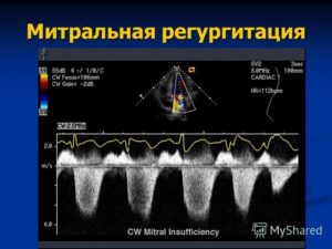 Регургитация 2-3 степени