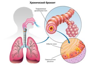 Перибронхит?