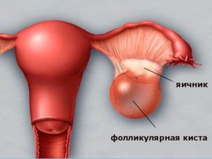Киста на фоне приема Жанина