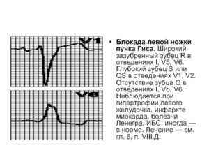 Отсутствие зубца R на V2