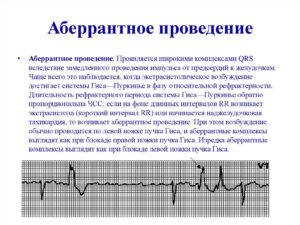 Аберрантный желудочковый комплекс, аберрантный суправентрикулярный комплекс