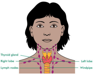 Щитовидная железа и увеличение лимфоузлов