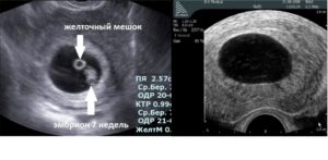 Не видно эмбриона при желточном мешочке 5,7мм