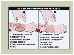 Сыпь при менингите