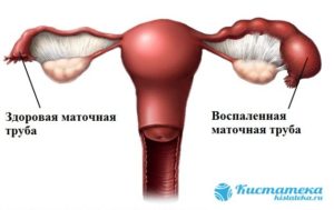Киста на маточной трубе
